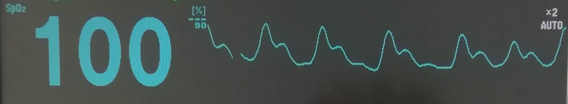 Oxymétrie de pouls en anesthésie : un outil simple, mais indispensable pour la sécurité du patient