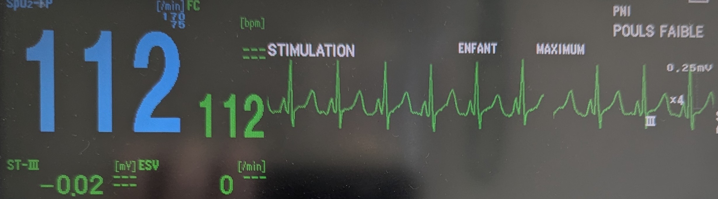 ECG en anesthésie : un outil de cohérence et de sécurité pour les ASV